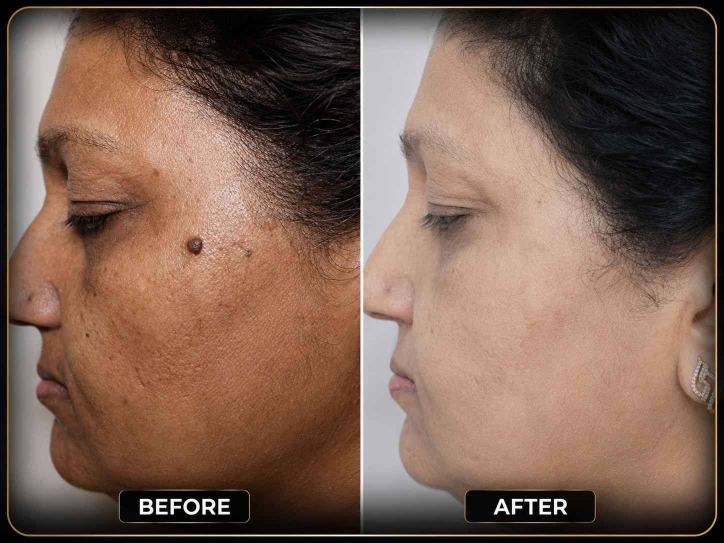Mole Removal - 30 Minutes